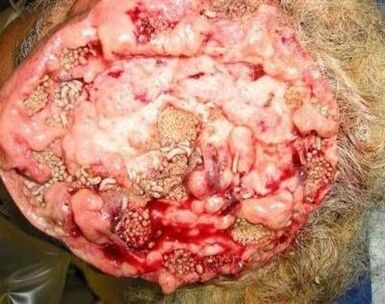 parazitai žmogaus smegenyse